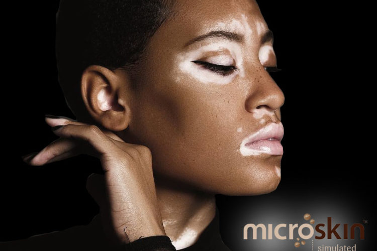 7 facts you didn’t know about Vitiligo