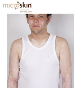 Disease, condition or disorder; how we talk about Vitiligo matters!