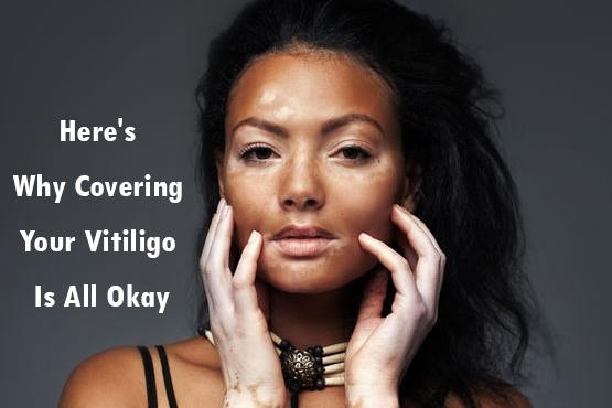 Here's Why Covering Your Vitiligo Is All Okay