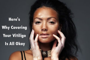 Heres-Why-Covering-Your-Vitiligo-Is-All-Okay