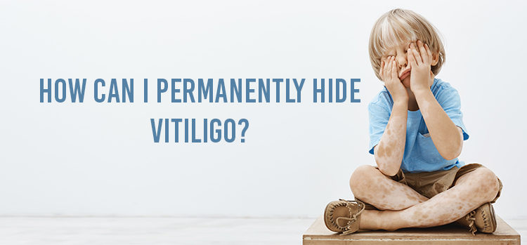How can I permanently hide vitiligo
